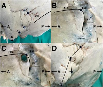 Developing a Method to Precisely Locate the Keypoint During Craniotomy Using the Retrosigmoid Keyhole Approach: Surgical Anatomy and Technical Nuances